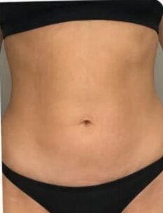 Antes e depois de cliente da Glamour Estética Feminina