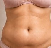 Antes e depois de cliente da Glamour Estética Feminina