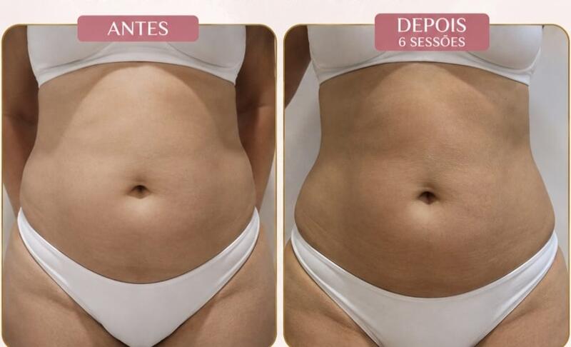 Antes e depois de cliente da Glamour Estética Feminina