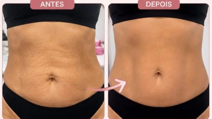 Antes e depois de cliente da Glamour Estética Feminina
