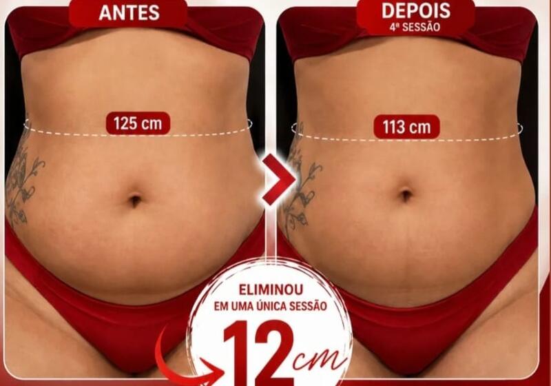 Antes e depois de cliente da Glamour Estética Feminina