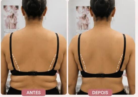 Antes e depois de cliente da Glamour Estética Feminina