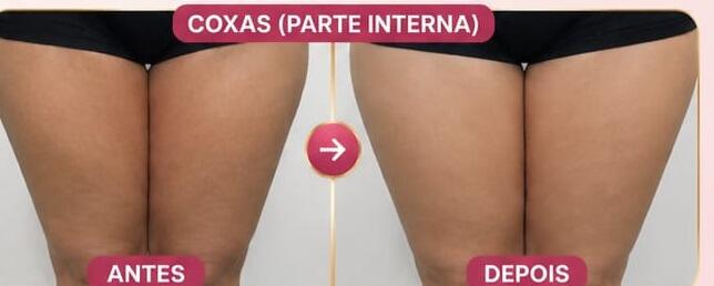 Antes e depois de cliente da Glamour Estética Feminina