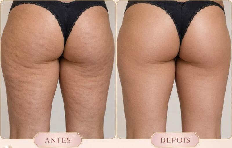 Antes e depois de cliente da Glamour Estética Feminina
