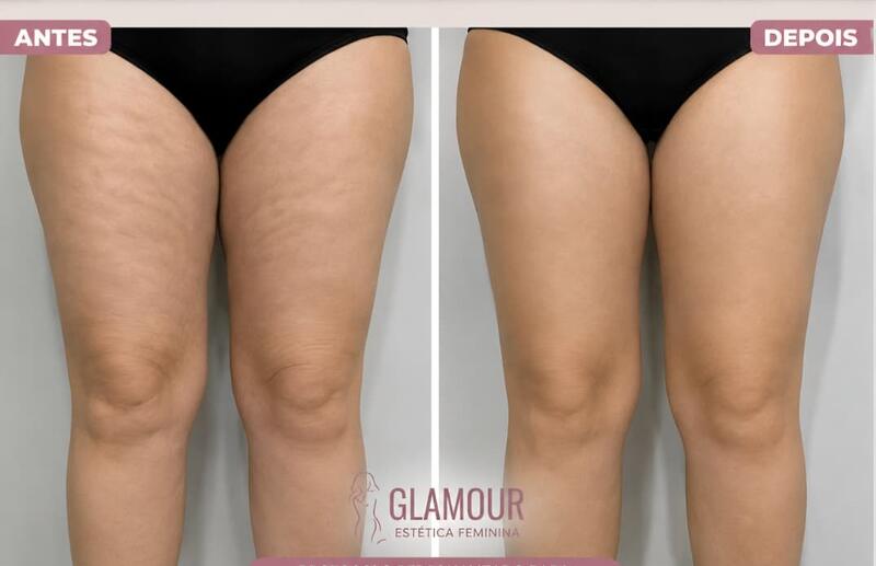 Antes e depois de cliente da Glamour Estética Feminina