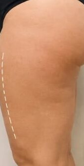 Antes e depois de cliente da Glamour Estética Feminina