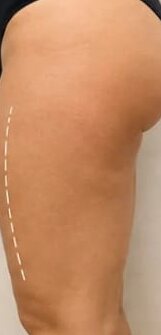 Antes e depois de cliente da Glamour Estética Feminina
