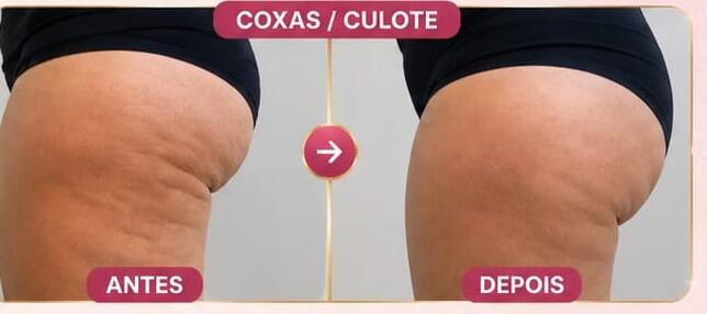 Antes e depois de cliente da Glamour Estética Feminina