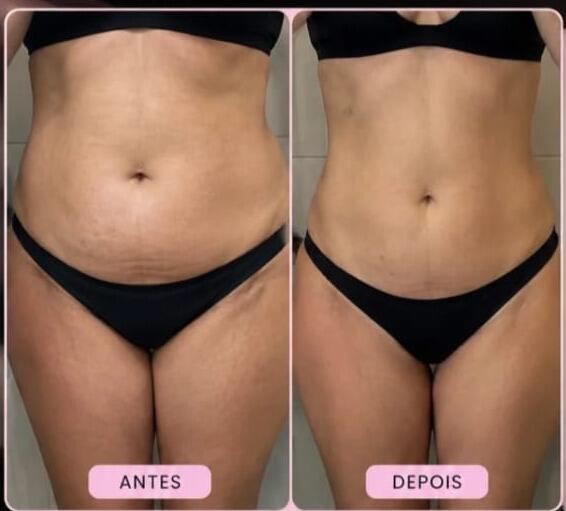 Antes e depois de cliente da Glamour Estética Feminina
