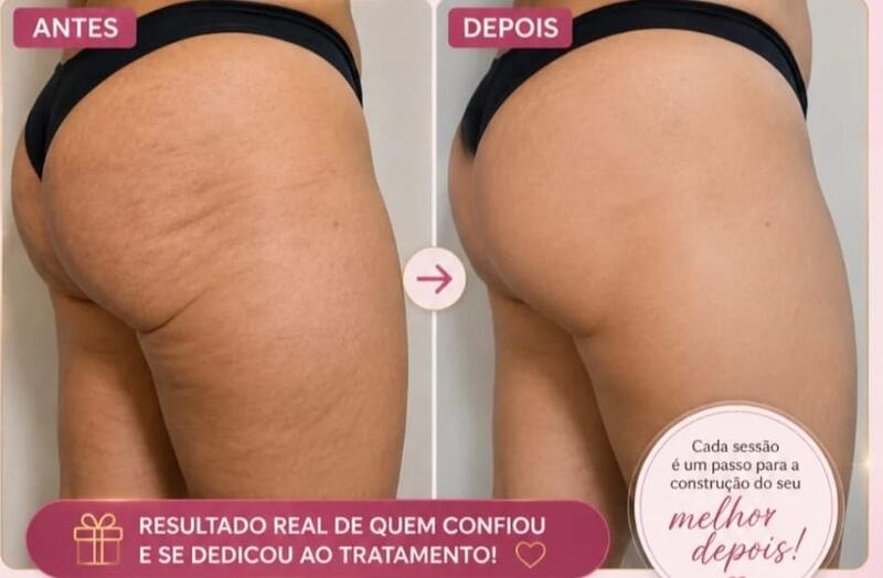 Antes e depois de cliente da Glamour Estética Feminina