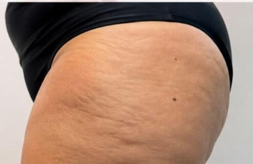 Antes e depois de cliente da Glamour Estética Feminina