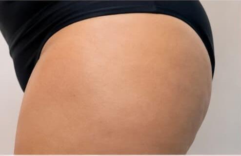 Antes e depois de cliente da Glamour Estética Feminina