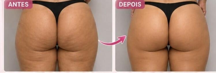 Antes e depois de cliente da Glamour Estética Feminina