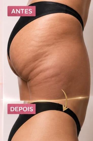 Antes e depois de cliente da Glamour Estética Feminina