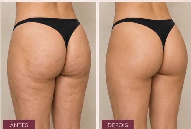 Antes e depois de cliente da Glamour Estética Feminina