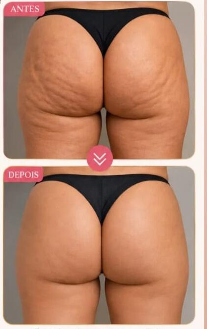 Antes e depois de cliente da Glamour Estética Feminina