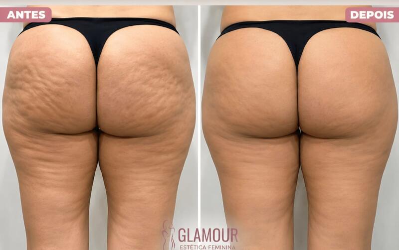 Antes e depois de cliente da Glamour Estética Feminina