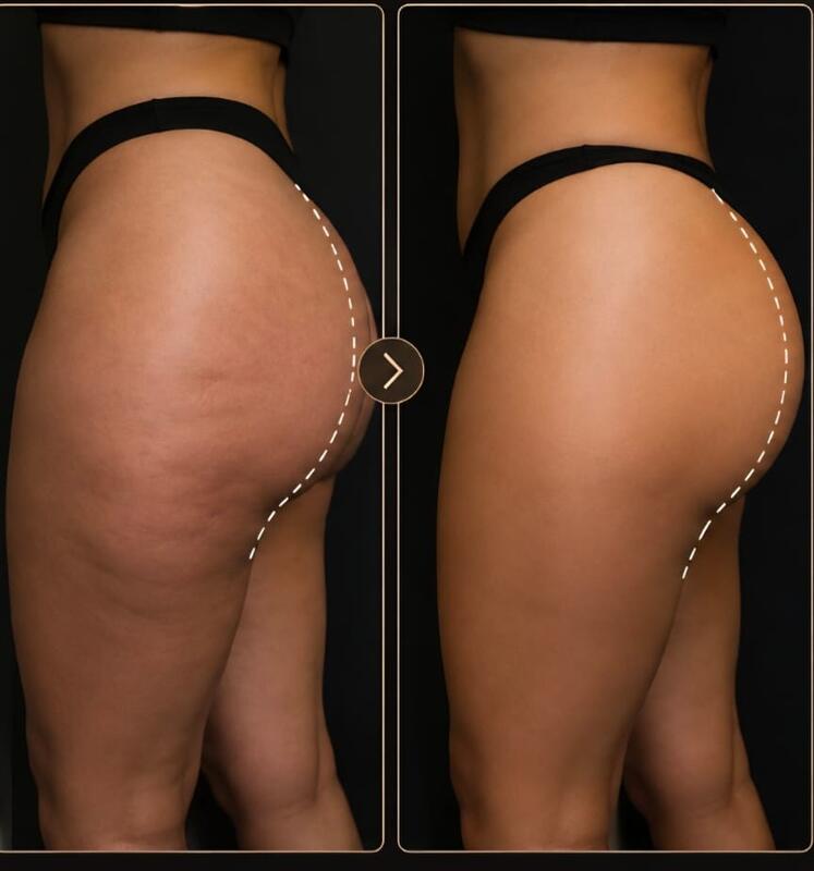 Antes e depois de cliente da Glamour Estética Feminina