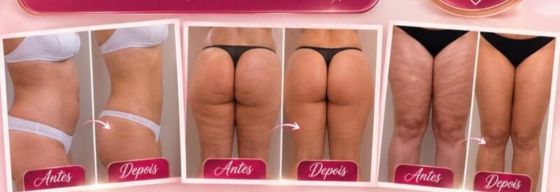 Antes e depois de cliente da Glamour Estética Feminina