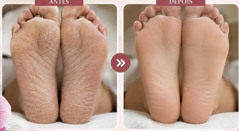 Antes e depois de cliente da Glamour Estética Feminina